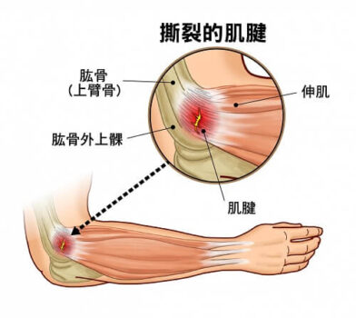 網球肘高爾夫球肘 Dr Sky 名冠診所