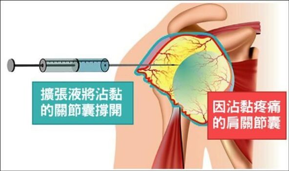 五十肩 不是50歲後才有的專利肩關節囊擴張術簡介 Dr Sky 名冠診所