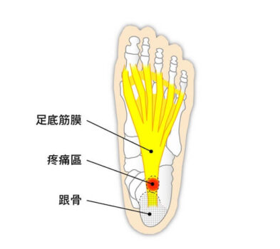 足底筋膜炎 Dr Sky 名冠診所