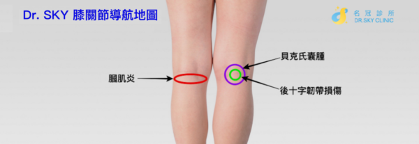 膝關節痛位置圖 膝蓋後側