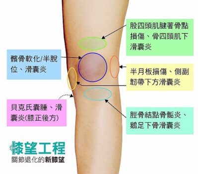 膝望工程 是什麼 它如何助你擺脫膝蓋疼痛 Dr Sky 名冠診所